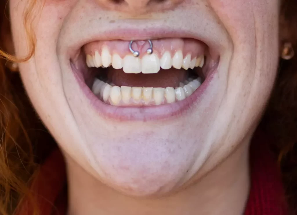 يحذر أطباء تقويم الأسنان من أن الثقب المبتسم يمكن أن يشكل مخاطر